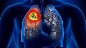 مقابله با عفونت ریه با استفاده از دستگاه بخور